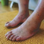 Diabetic Foot