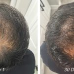 Hair Restoration