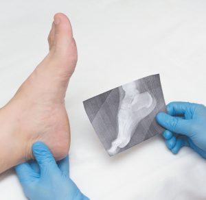 Plantar Fasciitis