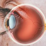 Understanding Glaucoma