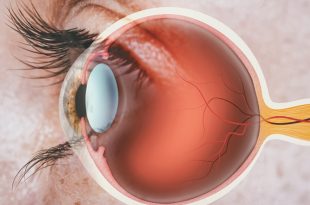 Understanding Glaucoma