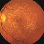 Macular Degeneration