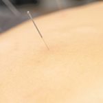 Acupuncture