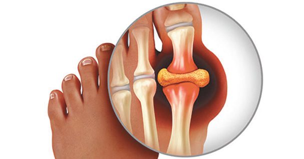 Gout Got Your Feet? Here’s What You Need to Know