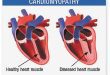 Understanding the Heart’s Toll: Alcohol-Induced Cardiomyopathy and Holiday Heart Syndrome