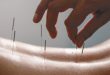 Acupuncture and Traditional Chinese Medicine in Mental Health