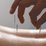 Acupuncture