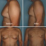 Gynecomastia Treatment