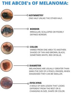 Melanoma