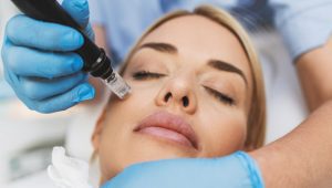 Microneedling