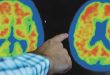 Alzheimer’s PET Imaging: A Window into Brain Changes