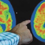 Alzheimer’s PET Imaging