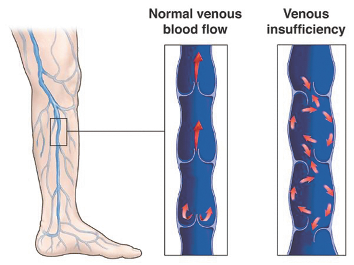 Understanding Chronic Venous Insufficiency • Southwest Floridas Health