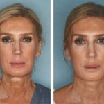 Facelift Options