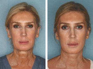 Facelift Options