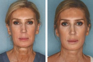 Facelift Options