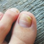 NAIL FUNGUS