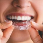 Orthodontic Aligner