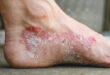 Psoriasis and your feet