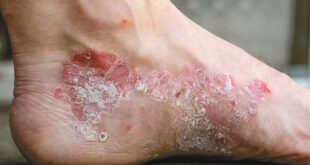 Psoriasis