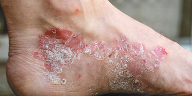 Psoriasis and your feet