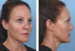 Revitalize Your Skin with Sculptra: The Collagen-Boosting Injectable