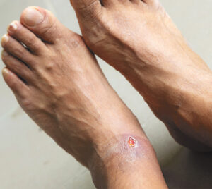 Diabetic Wound Care