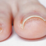 Ingrown toe nail