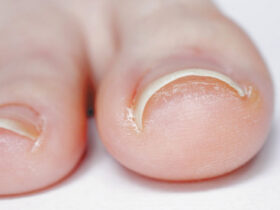 Ingrown toe nail