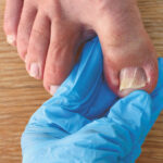 Ingrown toe nail