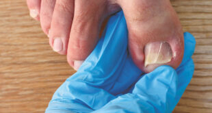 Ingrown toe nail