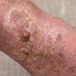 Lymphedema