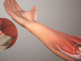 Golfer's Elbow