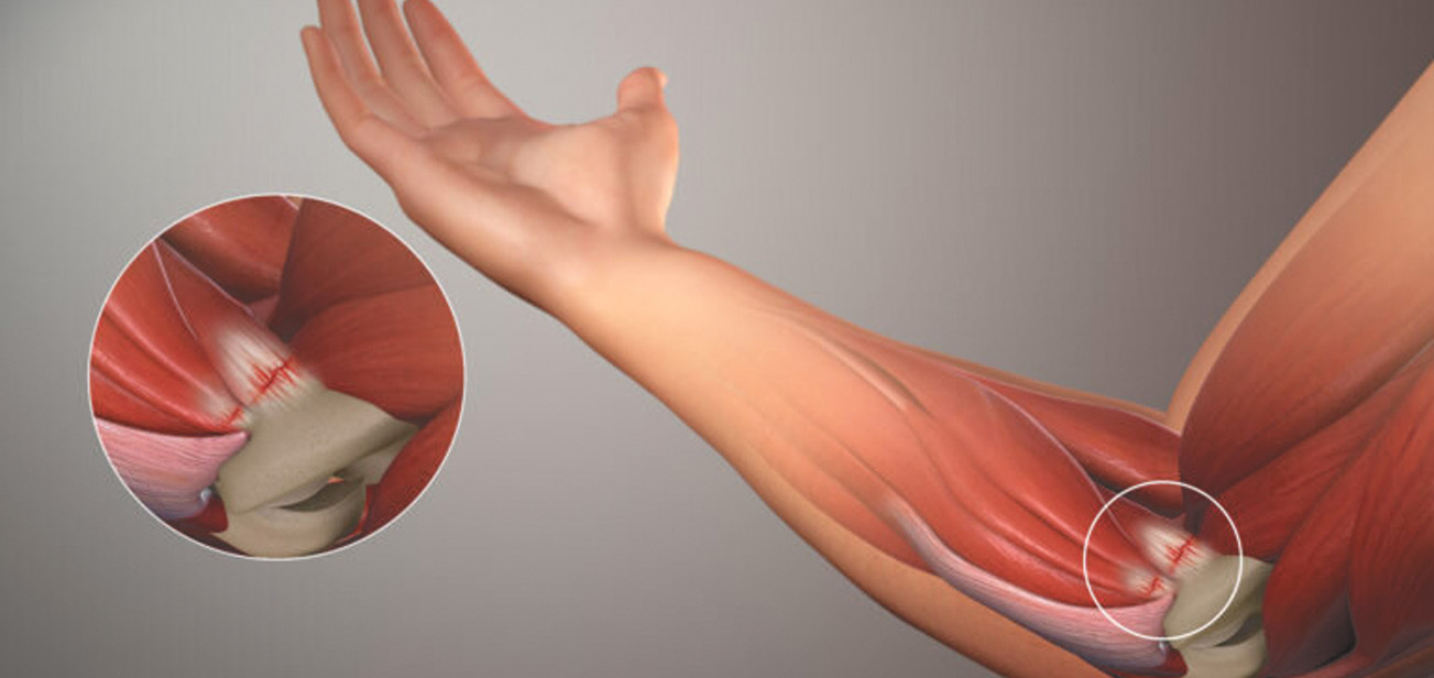 Golfer's Elbow