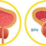 Prostate Treatments