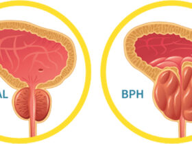 Prostate Treatments