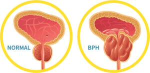 Prostate Treatments