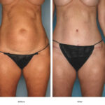 Tummy Tuck