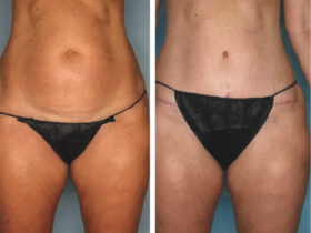 Tummy Tuck