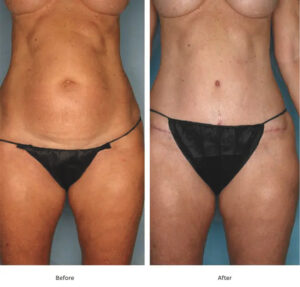 Tummy Tuck