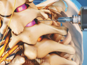 Caudal Steroid Injections