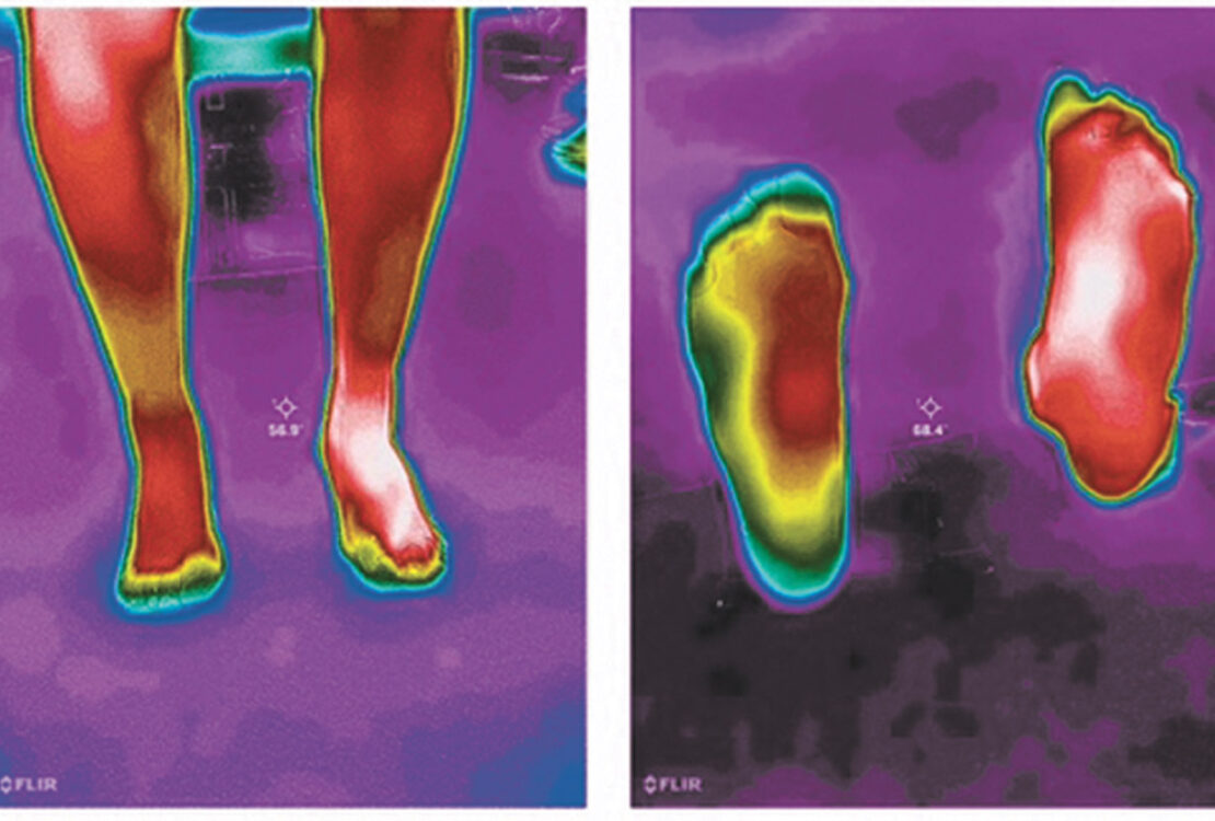 Neuropathy