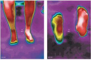 Neuropathy