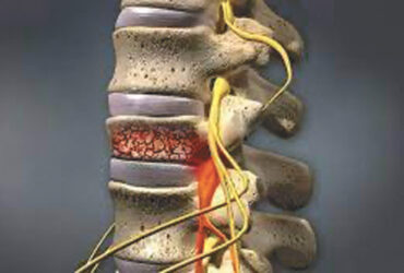Spinal Stenosis
