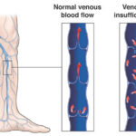 Venous Insufficiency