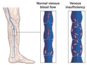 Venous Insufficiency