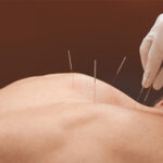 Acupuncture