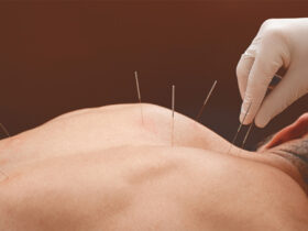 Acupuncture
