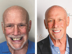 Full-Arch Implant