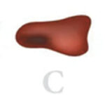 Melanoma